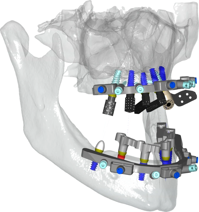CHROME GuidedSMILE stackable guide system positioned on a full-arch mandible